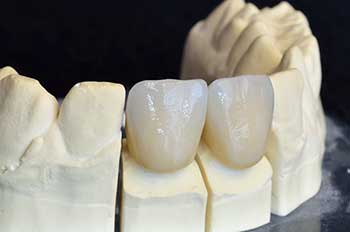 Dental Crowns in Lumberton