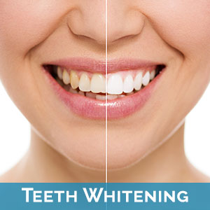 Lumber Bridge Teeth Whitening