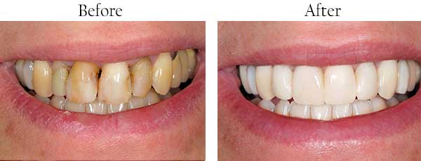 Lumberton Before and After Teeth Whitening