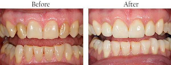 Fairmont Before and After Invisalign