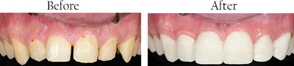 Lumberton Before and After Invisalign