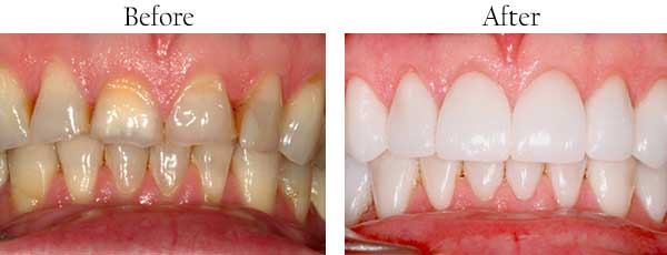 Fairmont Before and After Dental Implants