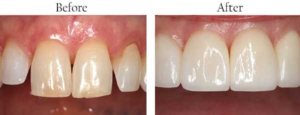Lumber Bridge Before and After Teeth Whitening