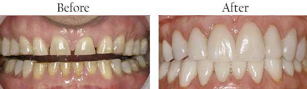 Lumberton Before and After Invisalign