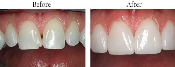 Fairmont Before and After Dental Implants